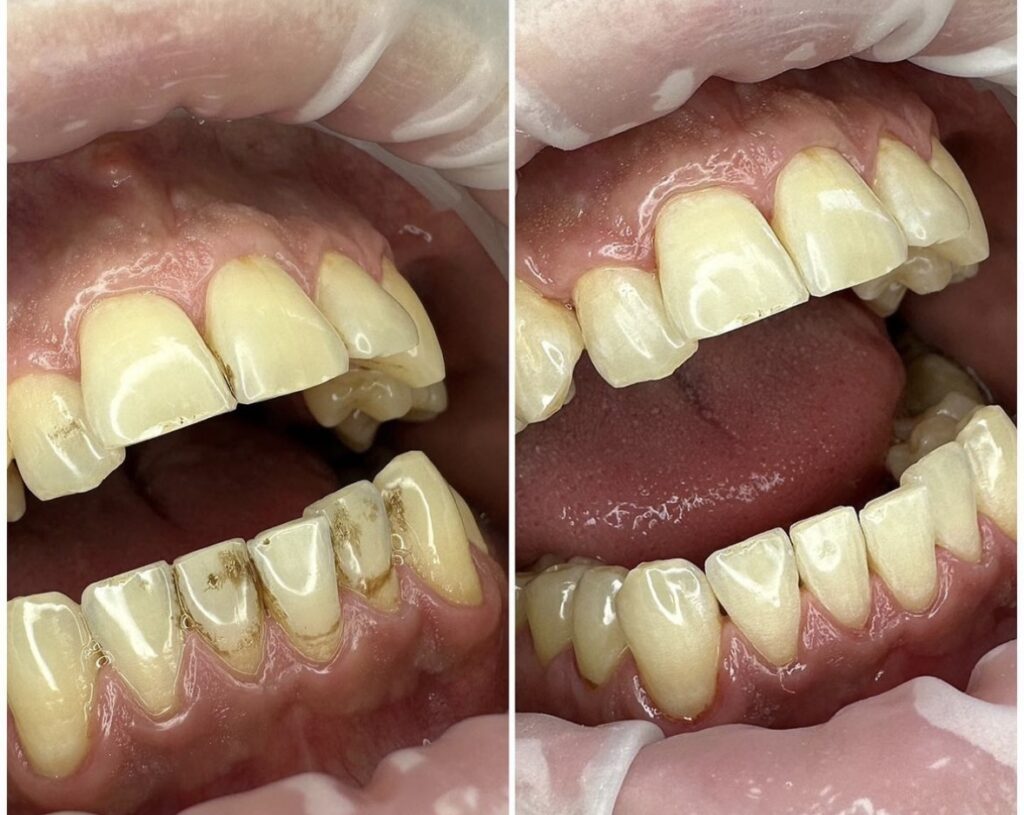 Dentálhigiéniai kezelés