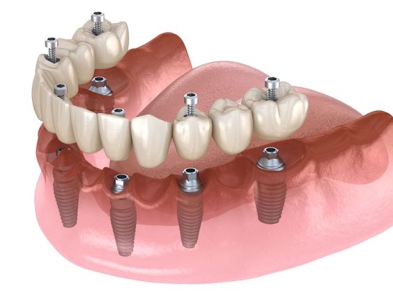 Implantátum beültetése